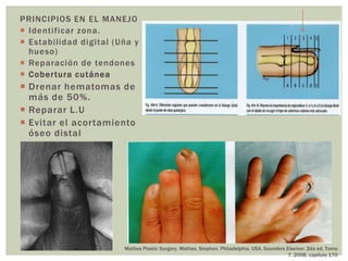 PRINCIPIOS EN EL MANEJO
 Identificar zona.
 Estabilidad digital (Uña y
  hueso)
 Reparación de tendones
 Cober tura cutánea
 Drenar hematomas de
  más de 50%.
 Reparar L.U
 Evitar el acortamiento
  óseo distal




                        Mathes Plastic Surgery. Mathes, Stephen. Philadelphia, USA. Saunders Elseiver. 2da ed. Tomo
                                                                                              7. 2008. capitulo 170
 