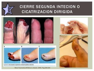 CIERRE SEGUNDA INTECION O
                 CICATRIZACION DIRIGIDA
   Zona 1 y algunos zona2.
   Perdida superficial.
   Lesiones de hasta 1 cm.
   Menos disestesias
   TX Puede durar 3-4 semanas
   Medidas desensibilizadoras
    (golpeteo y percusión)




         Mano Traumatica.M.Merle, G. Dautel. 1995, Pag.226-230
 