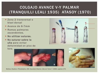 COLGAJO AVANCE V-Y PALMAR
    (TRANQUILLI LEALI 1935) ATASOY (1970)
 Zona 2 transversal o
  bisel dor sal
 Avance de 6-7mm
 Ramas palmares
  ascendentes.
 No utilizar suturas.
 No suturar sobre la
  uña para evitar
  deformidad en pico de
  loro.




Mathes, Stephen. Philadelphia, USA. Saunders Elseiver. 2da ed. Tomo 7. 2008. capitulo 170.
 