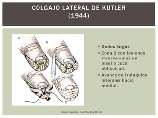 COLGAJO LATERAL DE KUTLER
          (1944)



                                         Dedos largos
                                         Zona 2 con lesiones
                                          transversales en
                                          bisel o poca
                                          oblicuidad.
                                         Avance de triángulos
                                          laterales hacia
                                          medial.




       Green’s operative Hand Surgery 5th Ed.
 