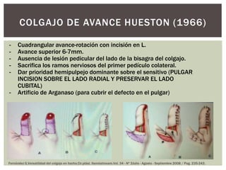 COLGAJO DE AVANCE HUESTON (1966)

-     Cuadrangular avance-rotación con incisión en L.
-     Avance superior 6-7mm.
-     Ausencia de lesión pedicular del lado de la bisagra del colgajo.
-     Sacrifica los ramos nerviosos del primer pedículo colateral.
-     Dar prioridad hemipulpejo dominante sobre el sensitivo (PULGAR
      INCISION SOBRE EL LADO RADIAL Y PRESERVAR EL LADO
      CUBITAL)
-     Artificio de Arganaso (para cubrir el defecto en el pulgar)




Fernández G.Versatilidad del colgajo en hacha.Cir.plást. iberolatinoam.Vol. 34 - Nº 3Julio - Agosto - Septiembre 2008 / Pag. 235-242.
 