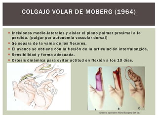 COLGAJO VOLAR DE MOBERG (1964)


 Incisiones medio -laterales y aislar el plano palmar proximal a la
  perdida. (pulgar por autonomía vascular dor sal)
 Se separa de la vaina de los flexores.
 El avance se obtiene con la flexión de la ar ticulación inter falangica.
 Sensibilidad y forma adecuada.
 Or tesis dinámica para evitar actitud en flexión a los 10 días.




                                                Green’s operative Hand Surgery 5th Ed.
 