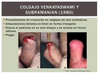 COLGAJO VENKATASWAMI Y
              SUBRAMANIAN (1980)
 Procedimiento de transición en colgajos de isla verdaderos.
 Amputaciones distales en bisel en forma triangular.
 Diseca el pedículo en un solo bloque y se avanza en forma
  oblicua.
 Pulgar




                                            Green’s operative Hand Surgery 5th Ed
 