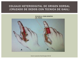 COLGAJO HETERODIGITAL DE ORIGEN DORSAL
(CRUZADO DE DEDOS CON TECNICA DE GAUL)

                     SE ALOJA LA RAMA SENSITIVA
                     DEL RADIAL




             Green’s operative Hand Surgery 5th Ed
 