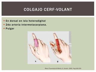 COLGAJO CERF-VOLANT

 En dorsal en isla heterodigital
 2da arteria intermetacarpiana.
 Pulgar




                               Mano Traumatica.M.Merle, G. Dautel. 1995, Pag.226-230
 