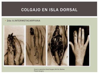 COLGAJO EN ISLA DORSAL

 2da A.INTERMETACARPIANA




                    Green’s operative Hand Surgery 5th Ed. Mathes
                    Plastic Surgery.
 