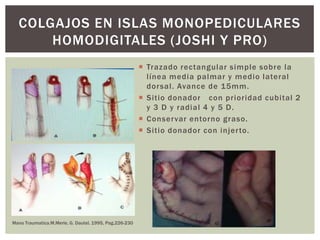 COLGAJOS EN ISLAS MONOPEDICULARES
      HOMODIGITALES (JOSHI Y PRO)
                                                         Trazado rectangular simple sobre la
                                                          línea media palmar y medio lateral
                                                          dor sal. Avance de 15mm.
                                                         Sitio donador con prioridad cubital 2
                                                          y 3 D y radial 4 y 5 D.
                                                         Conser var entorno graso.
                                                         Sitio donador con injer to.




Mano Traumatica.M.Merle, G. Dautel. 1995, Pag.226-230
 