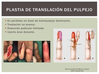 PLASTIA DE TRANSLACIÓN DEL PULPEJO

   En perdidas en bisel de hemipulpejo dominante.
   Traslación no avance.
   Disección pedículo limitada.
   injerto área donante.




                                              Mano Traumatica.M.Merle, G. Dautel.
                                                     1995, Pag.226-230
 