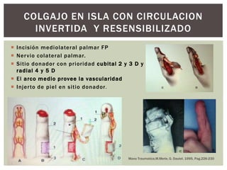 COLGAJO EN ISLA CON CIRCULACION
      INVERTIDA Y RESENSIBILIZADO
 Incisión mediolateral palmar FP
 Ner vio colateral palmar.
 Sitio donador con prioridad cubital 2 y 3 D y
  radial 4 y 5 D
 El arco medio provee la vascularidad
 Injer to de piel en sitio donador.




                                         Mano Traumatica.M.Merle, G. Dautel. 1995, Pag.226-230
 