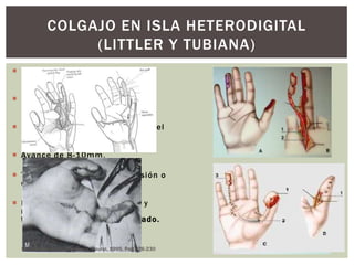 COLGAJO EN ISLA HETERODIGITAL
                 (LITTLER Y TUBIANA)
 Hemipulpejo funcionalmente
  menor.

 CUBITAL DEL 4D O 3D CON
  EXCEPCIONES.

 Incisión medio lateral, Se aísla el
  pedículo en bloque.

 Avance de 8 -10mm.

 Tunelización evitando la tensión o
  compresión del pedículo.

 Morbilidad del sitio donador y
  reorientación cor tical del
  territorio sensitivo t rasplantado.


  Mano Traumatica.M.Merle, G. Dautel. 1995, Pag.226-230
 