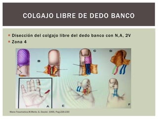 COLGAJO LIBRE DE DEDO BANCO

 Disección del colgajo libre del dedo banco con N,A , 2V
 Zona 4




Mano Traumatica.M.Merle, G. Dautel. 1995, Pag.226-230
 