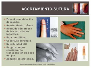 ACORTAMIENTO-SUTURA

 Zona 4 remodelación
  de muñón.
 Acortamiento 1-2mm
 Reanudación precoz
  de las actividades
  laborales.
 Baja morbilidad
 Cobertura duradera
 Sensibilidad útil
 Pulgar siempre
  considerar la
  transposición de dedo
  del pie.
 Adaptación protésica.
            Mano Traumatica.M.Merle, G. Dautel. 1995, Pag.226-230
 
