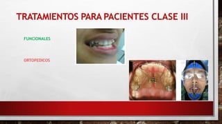 TRATAMIENTOS PARA PACIENTES CLASE III
FUNCIONALES
ORTOPEDICOS
 