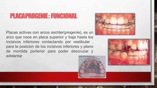 Placas activas con arcos eschler(progenie), es un
arco que nace en placa superior y baja hasta los
incisivos inferiores contactando por vestibular ,
para la posicion de los incisivos inferiores y plano
de mordida porterior para poder descruzar y
adelantar
PLACAPROGENIE: FUNCIONAL
 