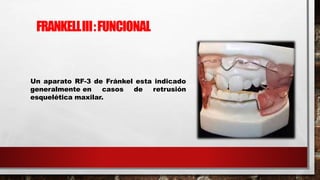 Un aparato RF-3 de Fránkel esta indicado
generalmente en casos de retrusión
esquelética maxilar.
FRANKELLIII:FUNCIONAL
 