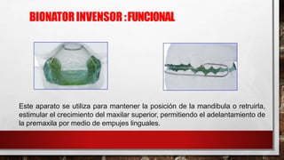 BIONATORINVENSOR :FUNCIONAL
Este aparato se utiliza para mantener la posición de la mandibula o retruirla,
estimular el crecimiento del maxilar superior, permitiendo el adelantamiento de
la premaxila por medio de empujes linguales.
 