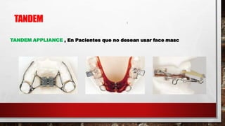 TANDEM APPLIANCE , En Pacientes que no desean usar face masc
TANDEM
 