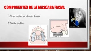 4.Férula maxilar de adhesión directa
5.Tracción elástica
COMPONENTES DE LA MASCARAFACIAL
 