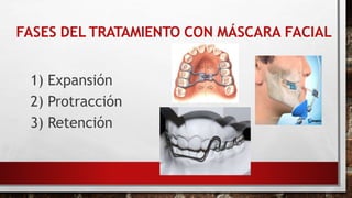 FASES DEL TRATAMIENTO CON MÁSCARA FACIAL
1) Expansión
2) Protracción
3) Retención
 
