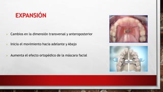  Cambios en la dimensión transversal y anteroposterior
 Inicia el movimiento hacia adelante y Abajo
 Aumenta el efecto ortopédico de la máscara facial
EXPANSIÓN
 