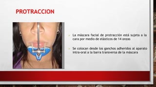 PROTRACCION
 La máscara facial de protracción está sujeta a la
cara por medio de elásticos de 14 onzas
 Se colocan desde los ganchos adheridos al aparato
intra-oral a la barra transversa de la máscara
 