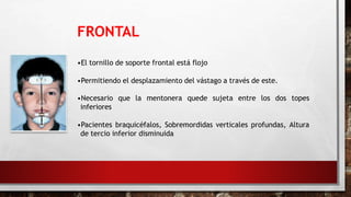 FRONTAL
•El tornillo de soporte frontal está flojo
•Permitiendo el desplazamiento del vástago a través de este.
•Necesario que la mentonera quede sujeta entre los dos topes
inferiores
•Pacientes braquicéfalos, Sobremordidas verticales profundas, Altura
de tercio inferior disminuida
 