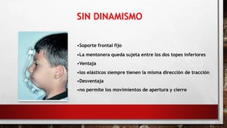 SIN DINAMISMO
•Soporte frontal fijo
•La mentonera queda sujeta entre los dos topes inferiores
•Ventaja
•los elásticos siempre tienen la misma dirección de tracción
•Desventaja
•no permite los movimientos de apertura y cierre
 