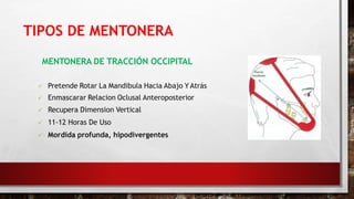 MENTONERA DE TRACCIÓN OCCIPITAL
 Pretende Rotar La Mandibula Hacia Abajo Y Atrás
 Enmascarar Relacion Oclusal Anteroposterior
 Recupera Dimension Vertical
 11-12 Horas De Uso
 Mordida profunda, hipodivergentes
ORTOPEDIA MAXILAR Y DIAGNOSTICO TOMAS RAKOSY , EDICION 1 -2007
TIPOS DE MENTONERA
 
