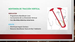 MENTONERA DE TRACCIÓN VERTICAL
INDICACION
 Prognatismo Mandibular Leve
 Con Aumento De La Dimensión Vertical
 Con Mordidas Abiertas Anteriores
EFECTO
 Disminuye Angulo Goniaco
 Rotacion Mandibular Hacia Arriba YAdelante
ORTOPEDIA MAXILAR Y DIAGNOSTICO TOMAS RAKOSY , EDICION 1 -2007
 