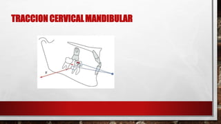 TRACCION CERVICALMANDIBULAR
 