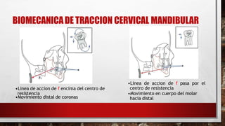 BIOMECANICADE TRACCION CERVICAL MANDIBULAR
•Linea de accion de f pasa por el
centro de resistencia
•Movimiento en cuerpo del molar
hacia distal
•Linea de accion de f encima del centro de
resistencia
•Movimiento distal de coronas
 