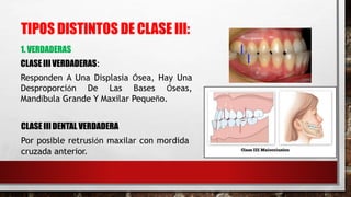 TIPOS DISTINTOS DE CLASE III:
1. VERDADERAS
CLASE III VERDADERAS:
Responden A Una Displasia Ósea, Hay Una
Desproporción De Las Bases Óseas,
Mandíbula Grande Y Maxilar Pequeño.
CLASE IIIDENTAL VERDADERA
Por posible retrusión maxilar con mordida
cruzada anterior.
 