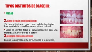 •FALSAS
2.CLASE IIIFALSA O SEUDOPROGENIE
Es caracterizada por un adelantamiento
funcional de la mandíbula en el cierre oclusal.
•Clase III dental falsa o pseudoprogenie con una
mordida anterior borde a borde.
3.MORDIDA CRUZADA ANTERIOR
En que la anomalía está circunscrita a la oclusión.
TIPOS DISTINTOS DE CLASE III:
 