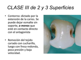 • Contorno: dictado por la
extensión de la caries. Se
puede dejar esmalte sin
soporte, a menos que
esté en contacto directo
con el antagonista
• Remoción del tejido
cariado con cucharilla,
luego con fresa redonda,
poca presión y baja
velocidad.
CLASE III de 2 y 3 Superficies
 