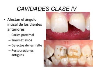 CAVIDADES CLASE IV
• Afectan el ángulo
incisal de los dientes
anteriores
– Caries proximal
– Traumatismos
– Defectos del esmalte
– Restauraciones
antiguas
 