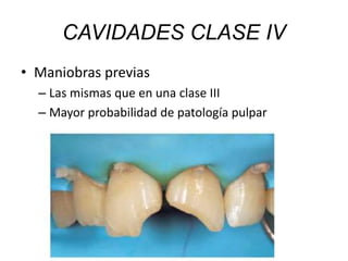 CAVIDADES CLASE IV
• Maniobras previas
– Las mismas que en una clase III
– Mayor probabilidad de patología pulpar
 