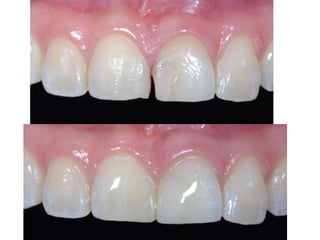 Preparaciones Clase iii, iv 