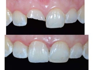 Preparaciones Clase iii, iv 