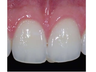 Preparaciones Clase iii, iv 