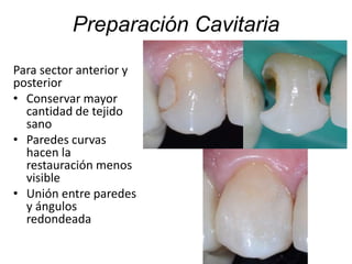 Preparación Cavitaria
Para sector anterior y
posterior
• Conservar mayor
cantidad de tejido
sano
• Paredes curvas
hacen la
restauración menos
visible
• Unión entre paredes
y ángulos
redondeada
 