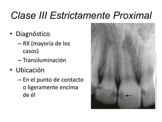 Clase III Estrictamente Proximal
• Diagnóstico
– RX (mayoría de los
casos)
– Transiluminación
• Ubicación
– En el punto de contacto
o ligeramente encima
de él
 