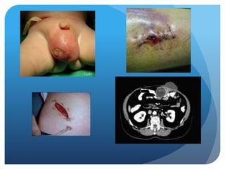  Clase infecciones en cirugía