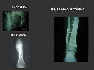   FRACTURAS DESPLAZADASFRACTURAS EXPUESTAS