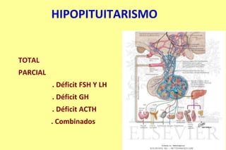 HIPOPITUITARISMO
TOTAL
PARCIAL
. Déficit FSH Y LH
. Déficit GH
. Déficit ACTH
. Combinados
 