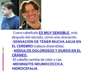 - Cuero cabelludo  ES MUY SENSIBLE , más después del rascado, como una ulceración.  - SENSACIÓN DE TENER MUCHA AGUA EN EL CEREBRO  (cabeza distendida).  -  NÓDULOS DOLOROSOS Y DUROS EN EL CRÁNEO.   -El cabello cambia de color y cae.  - MENINGITIS NEUMOCÓCCICA. HIDROCEFALIA. 