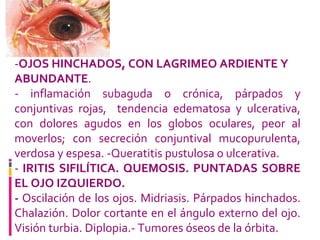 - OJOS HINCHADOS, CON LAGRIMEO ARDIENTE Y ABUNDANTE . - inflamación subaguda o crónica, párpados y conjuntivas rojas,  tendencia edematosa y ulcerativa, con dolores agudos en los globos oculares, peor al moverlos; con secreción conjuntival mucopurulenta, verdosa y espesa. -Queratitis pustulosa o ulcerativa. -  IRITIS SIFILÍTICA. QUEMOSIS. PUNTADAS SOBRE EL OJO IZQUIERDO. -  Oscilación de los ojos. Midriasis. Párpados hinchados. Chalazión. Dolor cortante en el ángulo externo del ojo. Visión turbia. Diplopia.- Tumores óseos de la órbita. 