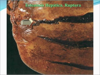 Esteatosis Hepática. Ruptura 