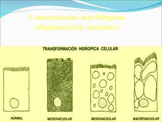 Dr. Julio Larenas H. MV, MSc Consecuencias morfológicas (degeneración vacuolar) 