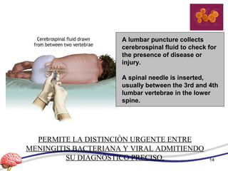 A lumbar puncture collects
cerebrospinal fluid to check for
the presence of disease or
injury.
A spinal needle is inserted,
usually between the 3rd and 4th
lumbar vertebrae in the lower
spine.
PERMITE LA DISTINCIÒN URGENTE ENTRE
MENINGITIS BACTERIANA Y VIRAL ADMITIENDO
SU DIAGNÒSTICO PRECISO. 14
 