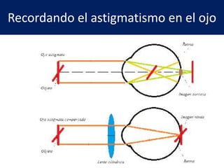 Recordando el astigmatismo en el ojo
 